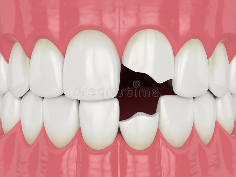 3d render of jaw with broken incisors teeth. 3d render of jaw with broken two incisors teeth vector illustration
