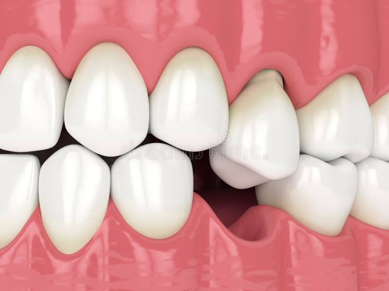 3d render of jaw with protruding tooth revealing root. Consequences of lower tooth loss stock illustration