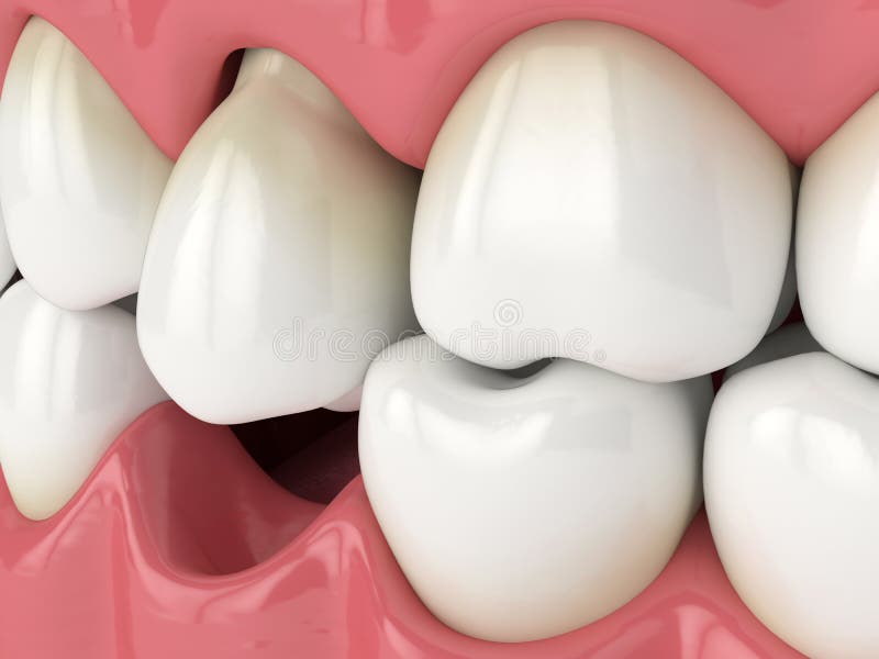 3d render of jaw with protruding tooth revealing root. Consequences of lower tooth loss royalty free illustration