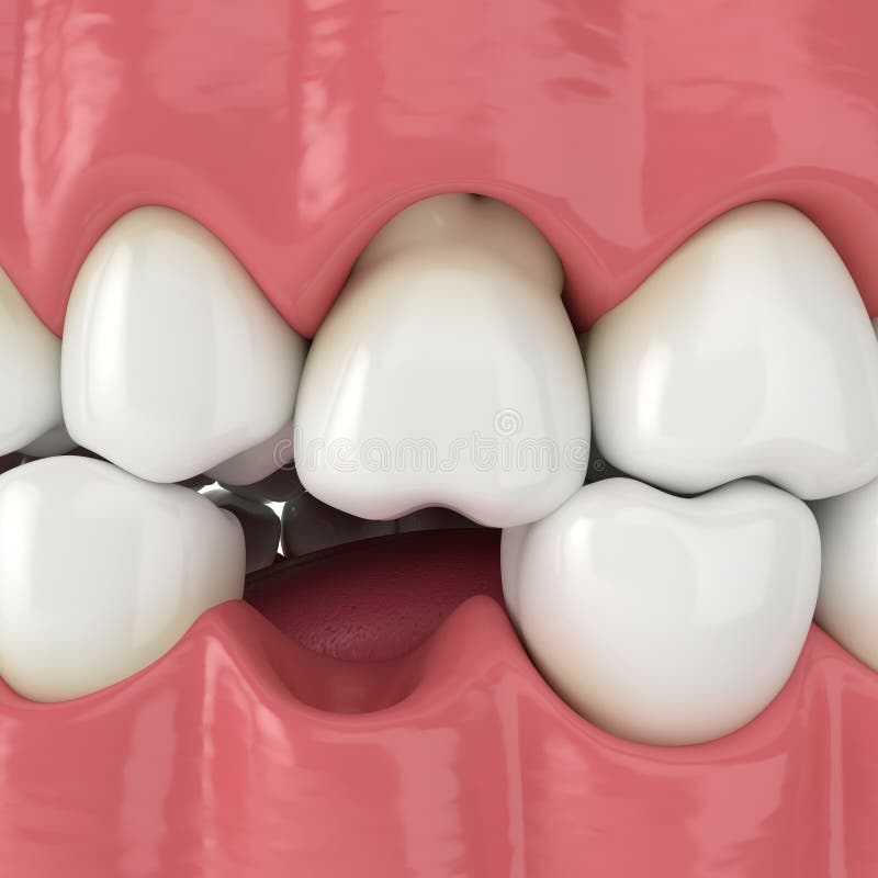 3d render of jaw with protruding tooth revealing root. Consequences of lower tooth loss vector illustration
