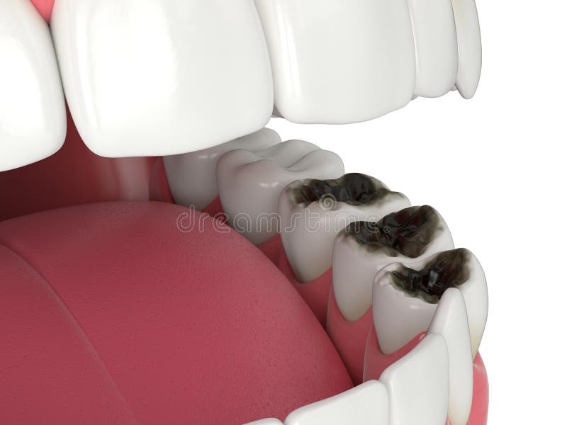 3d render of  jaw and teeth with caries. 3d render of jaw and teeth with caries over white background royalty free illustration