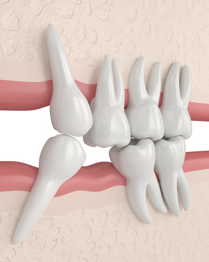 3d render of teeth sliding towards the area of missing tooth in order to fill the gap. Consequences of lower tooth loss royalty free illustration