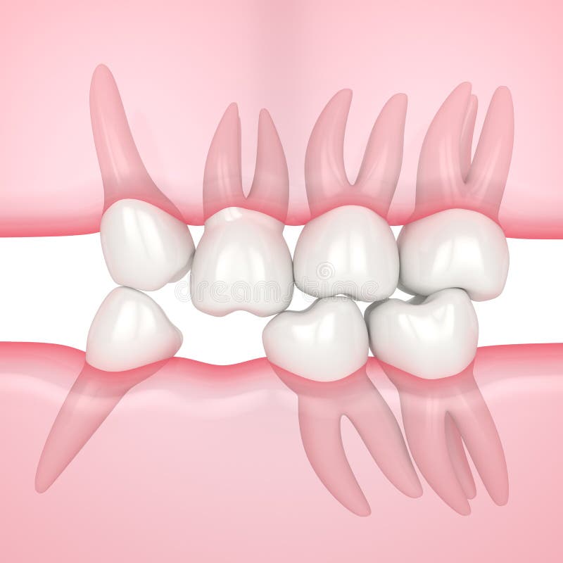3d render of teeth sliding towards the area of missing tooth in order to fill the gap. Consequences of lower tooth loss stock illustration