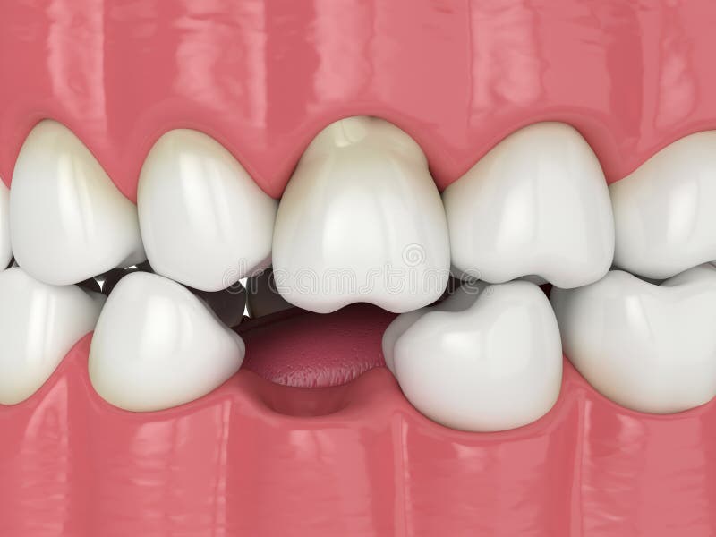 3d render of teeth sliding towards the area of missing tooth in order to fill the gap. Consequences of lower tooth loss vector illustration