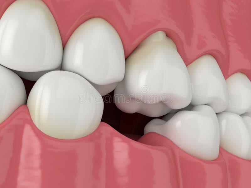 3d render of teeth sliding towards the area of missing tooth in order to fill the gap. 3d render of jaw with protruding molar tooth revealing root. Teeth sliding vector illustration