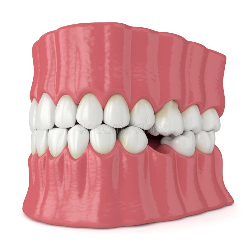 3d render of teeth sliding towards the area of missing tooth in order to fill the gap. 3d render of jaw with protruding tooth revealing root. Teeth sliding royalty free illustration