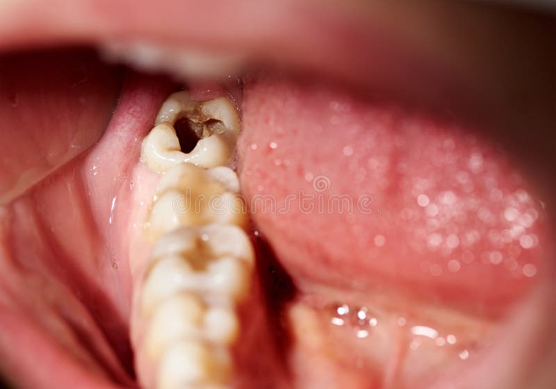 Damaged tooth with cavity dental caries decay royalty free stock photography