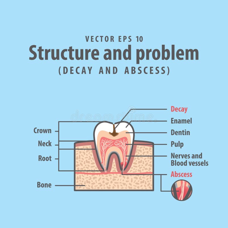 Decay and abscess cross-section structure inside tooth stock illustration