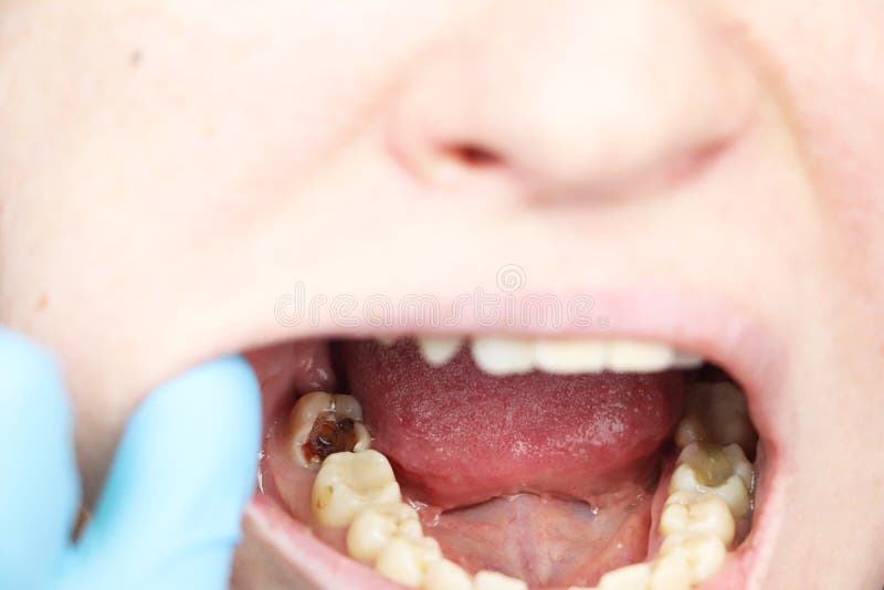 Deep caries, open canals, cleaning canals. Patient at stomatolon on admission, periodontitis treatment stock photos