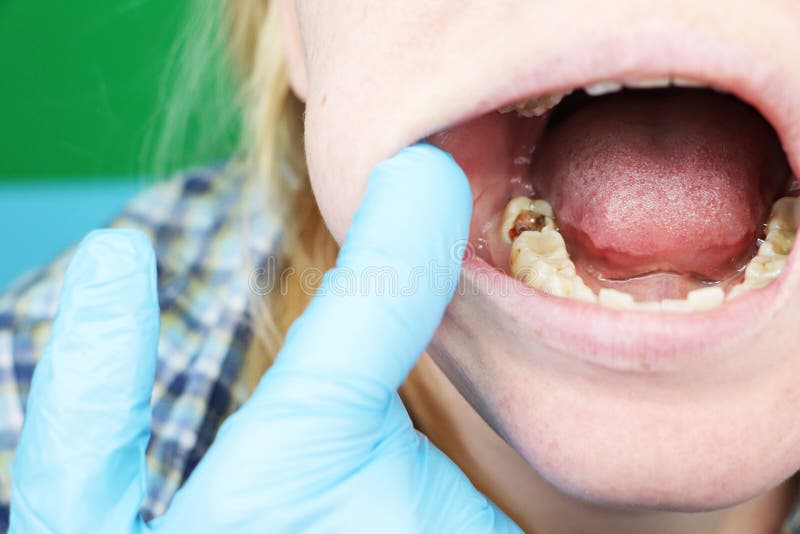 Deep caries, open canals, cleaning canals. Patient at stomatolon on admission, periodontitis treatment stock photos