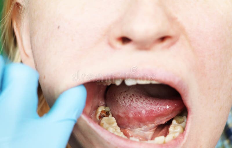 Deep caries, open canals, cleaning canals. Patient at stomatolon on admission, periodontitis treatment stock image