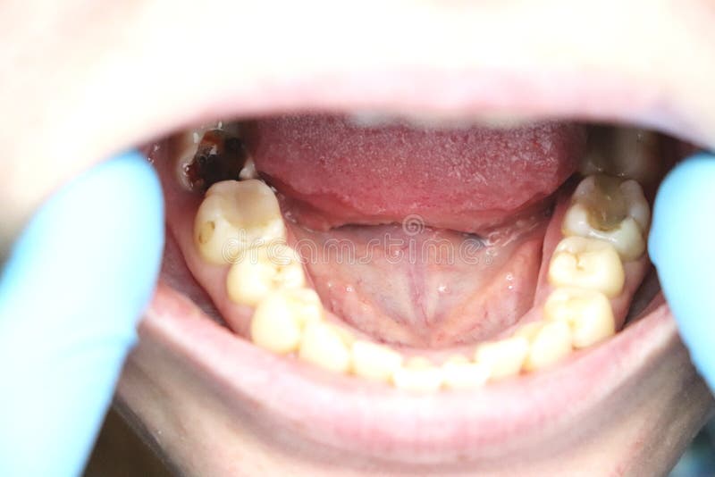 Deep caries, open canals, cleaning canals. Patient at stomatolon on admission, periodontitis treatment stock photography