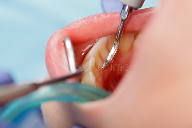 Dental calculus removing royalty free stock photo