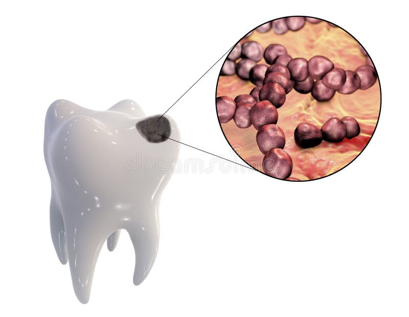 Dental caries and close-up view of microbes which cause caries. Tooth with dental caries and close-up view of microbes which cause caries Streptococcus mutans vector illustration