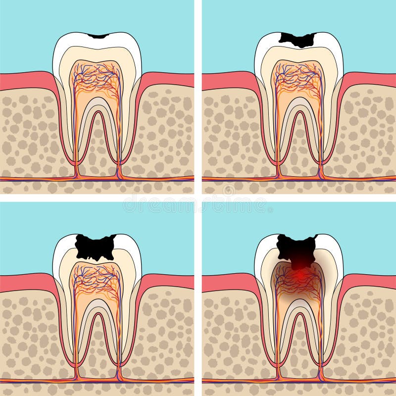 Dental caries stages. Cross section tooth anatomy and damage royalty free illustration