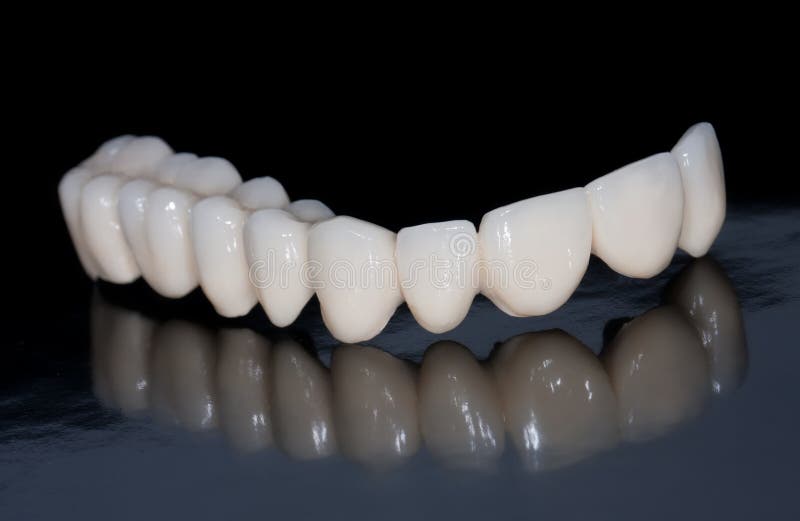 Dental bridge royalty free stock image