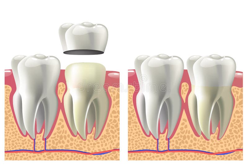 Dental crown installation process. Dental care concept. royalty free illustration