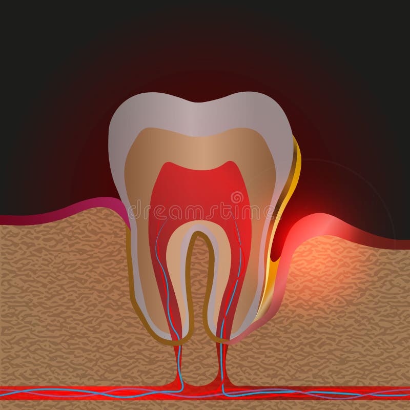 Dental disease with pain and inflammation. Medical illustration of tooth root inflammation, Gum disease, pus in the gum pocket,. Plaque and dental calculus royalty free illustration