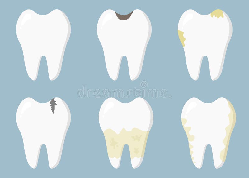 Dental diseases. Tooth decay, inflammation, dental plaque, periodontal disease. Concept of dentistry and medicine.  vector illustration