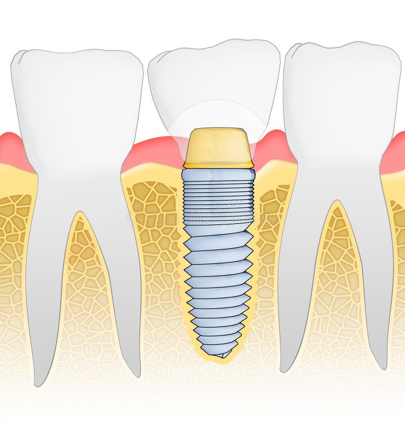 Dental Implant stock illustration
