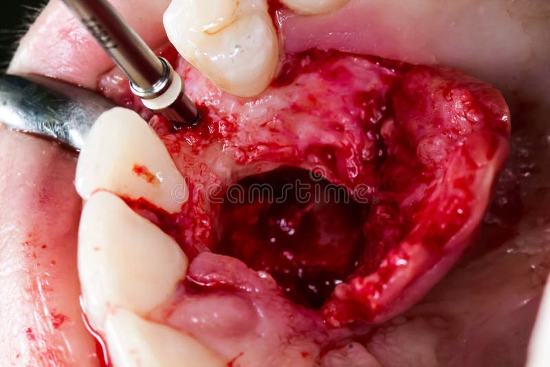 Dental implant placement in real pacint royalty free stock photo