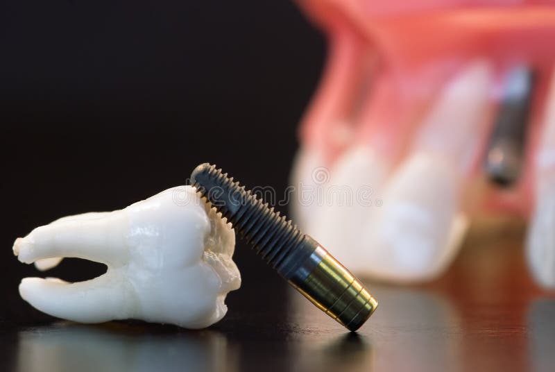 Dental implantation stock photo