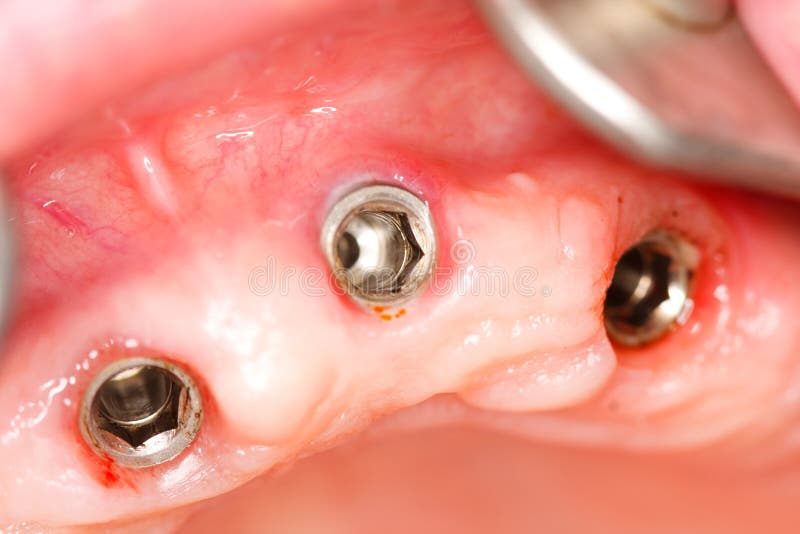 Dental implants royalty free stock image
