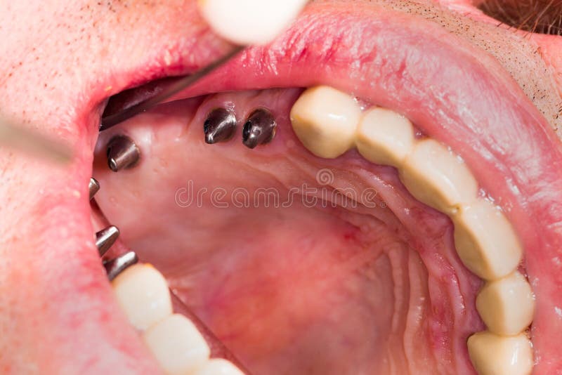 Dental implants royalty free stock photo