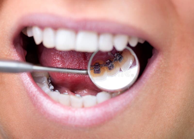 Dental mirror showing lingual braces. Female patient showing her invisible lingual braces braces on dental mirror stock photos