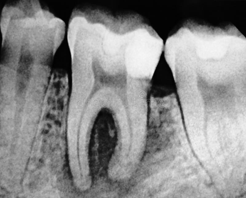Dental Molar X-ray. A black and white X-ray of a molar tooth stock photos