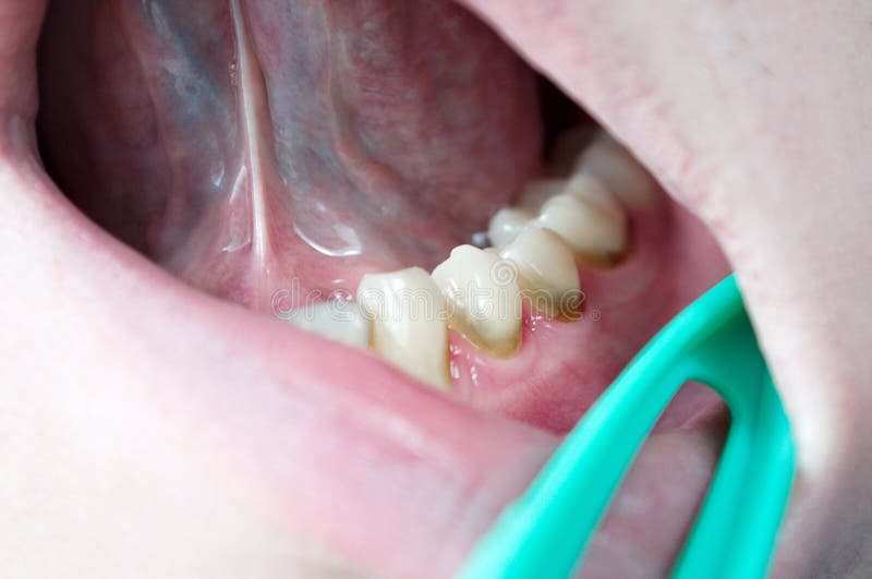 Dental plaque on teeth, caries, gingivitis, periodontitis, periodontal disease, tartar, professional oral hygiene, gingivitis. Bleeding gums stock photography
