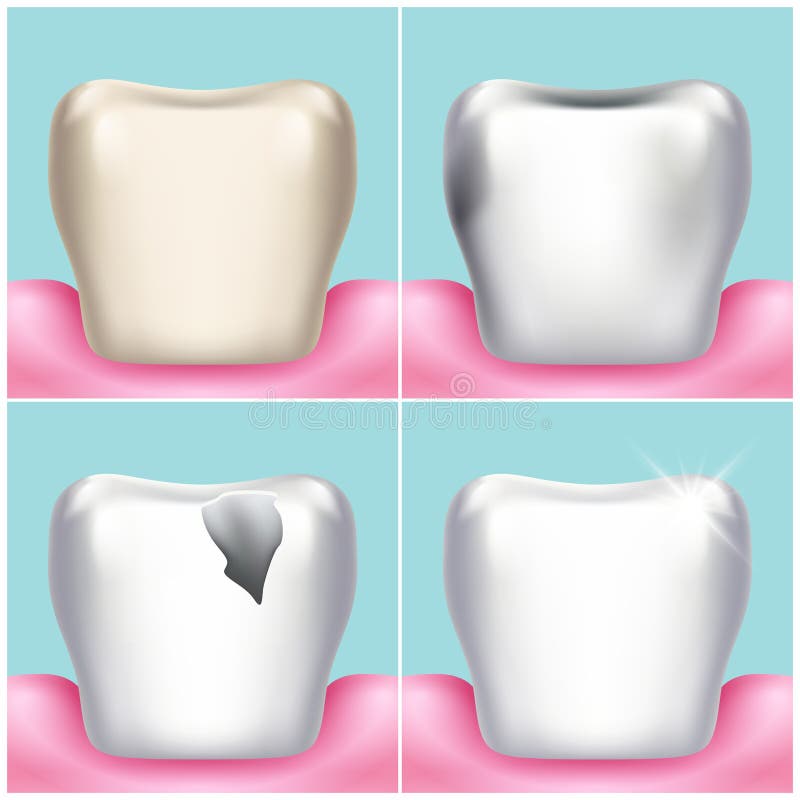 Dental problems, caries, plaque and gum disease, healthy tooth vector illustration. Stomatology and treat unhealthy teeth illustration stock illustration