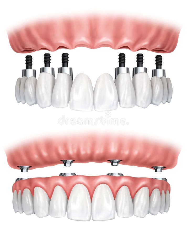 Dental prosthesis. Image of a denture prosthesis stock illustration