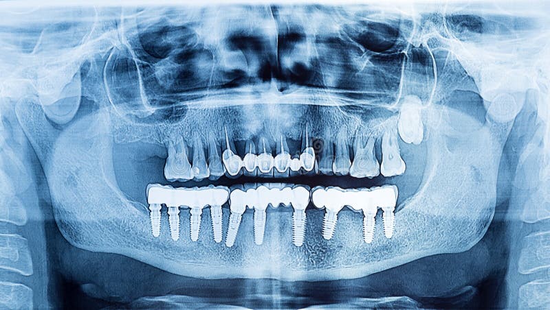 Dental X-Ray panoramic of upper and lower jaw.Dental implant pro royalty free stock images