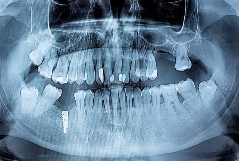 Dental x-ray with periodontitis problems, decayed teeth and implant. Sample royalty free stock image Dental x-ray with periodontitis problems, decayed teeth and implant. Sample royalty free stock image