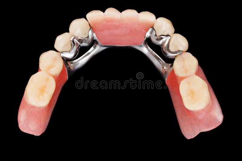 Dental skeletal prosthesis - upper vew royalty free stock images
