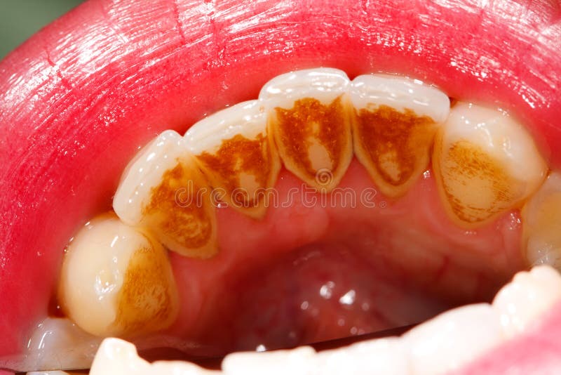 Dental plaque closeup stock photo