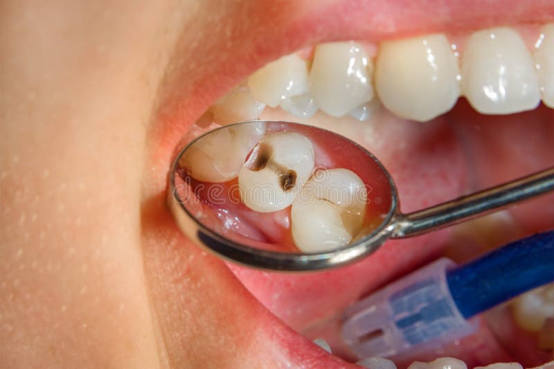 Dental treatment in dental clinic. Rotten carious tooth macro. T royalty free stock photography