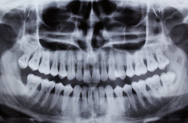 Dental Xray (x-ray) royalty free stock photos