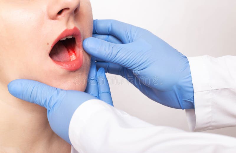 Dentist doctor examines the bite of the jaw of a girl and a bad tooth with pulpitis, gum disease, close-up, fluorosis. Dentist doctor examines the bite of the royalty free stock image
