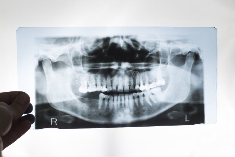 The dentist doctor holds in his hand an x-ray picture of the jaw with false teeth. Dental prosthetics concept with metal-ceramic. Crowns stock image