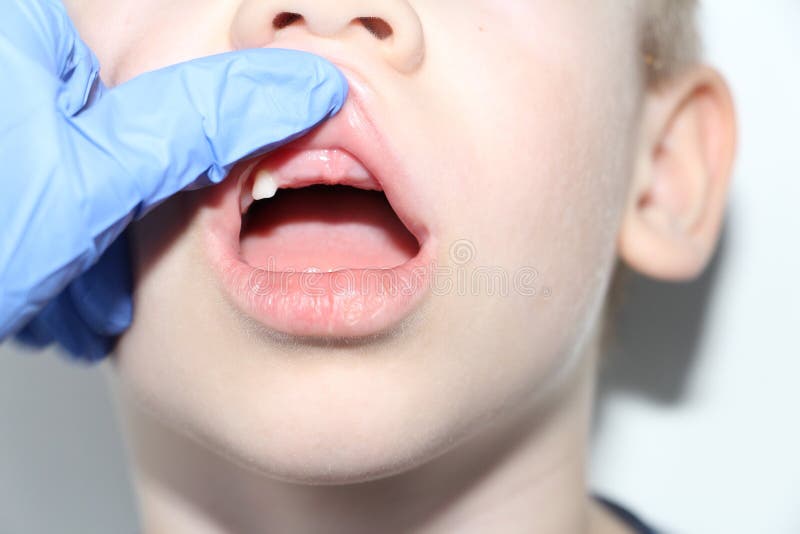 A dentist examines the baby teeth in the boy. The loss of milk teeth stock photography