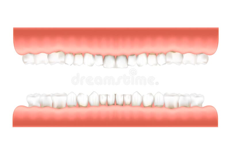 Dentition infographic chart with realistic human teeth in pink gum on upper and lower jaws isolated on white. Dentition infographic chart with realistic human royalty free illustration