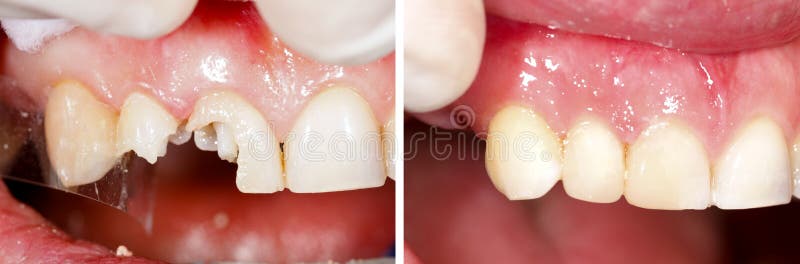Destructed teeth filling royalty free stock photos