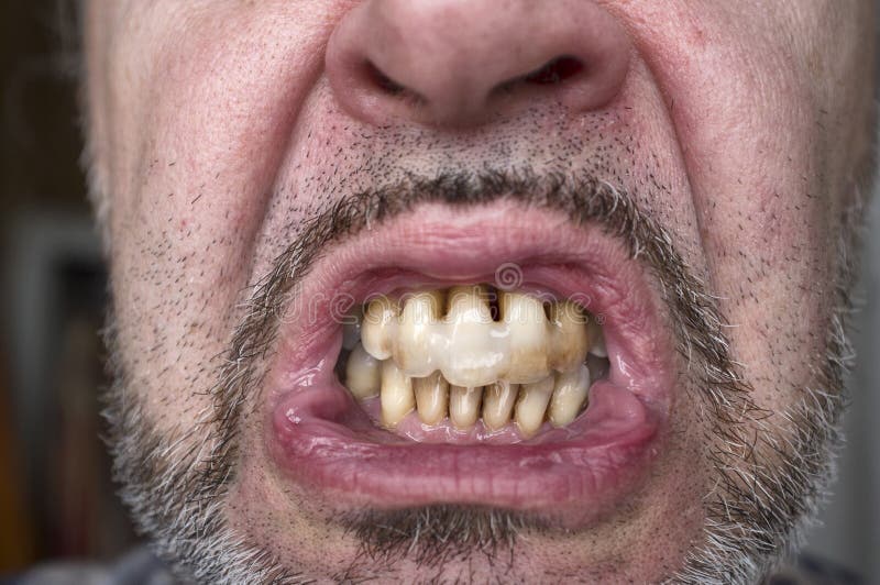 Teeth affected by periodontitis. Destructive periodontitis in a middle-aged man stock images Teeth affected by periodontitis. Destructive periodontitis in a middle-aged man stock images