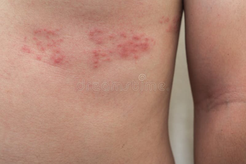 Detail of body skin with Herpes Zoster Shingles stock image