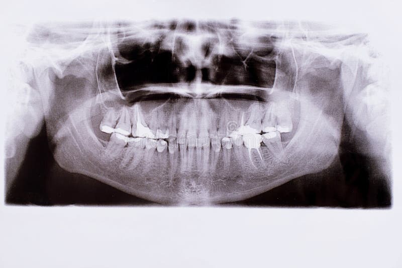 Detail of panoramic facial x-ray image royalty free stock image Detail of panoramic facial x-ray image royalty free stock image