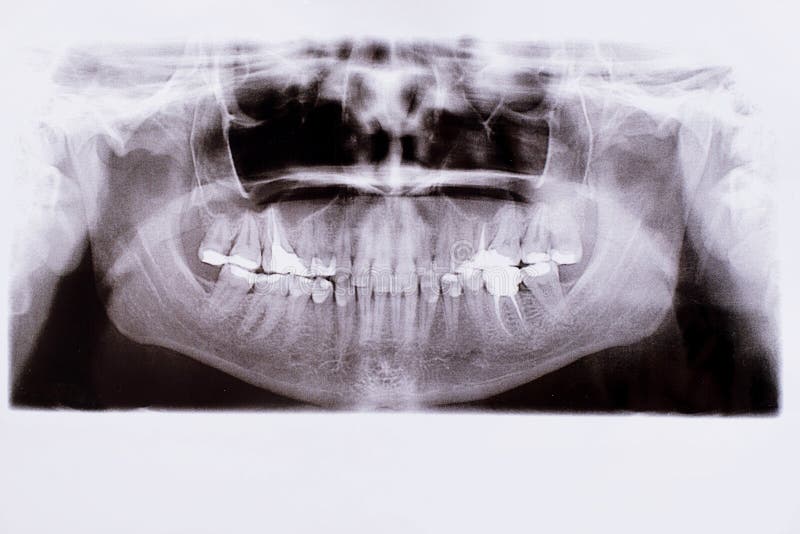 Detail of panoramic facial x-ray image royalty free stock image