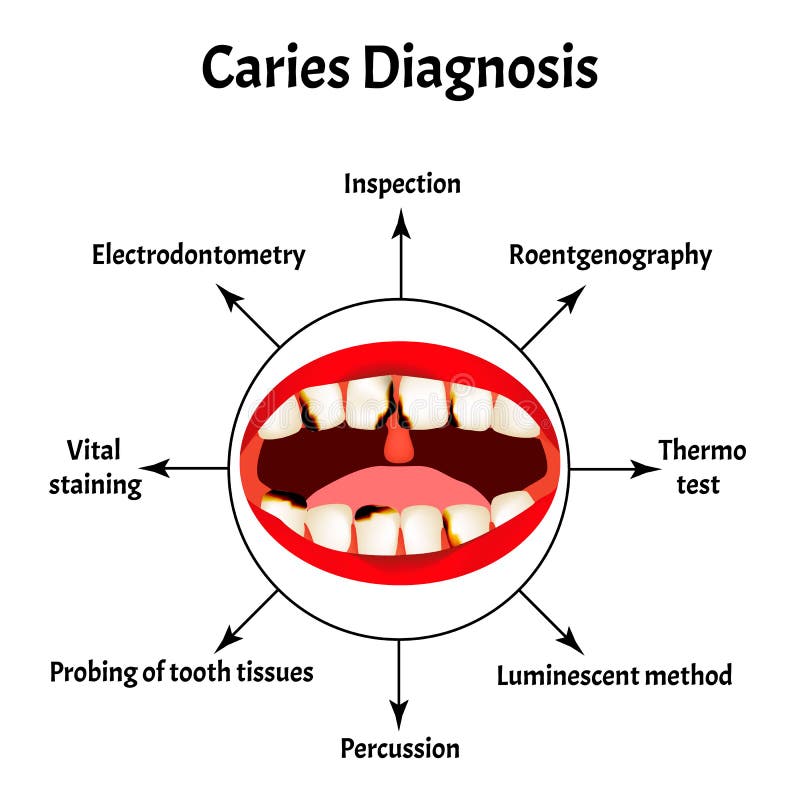 Diagnosis of caries. Bad breath. Halitosis. The structure of the teeth and oral cavity with caries. Diseases of the. Teeth. Infographics. Vector illustration on royalty free illustration