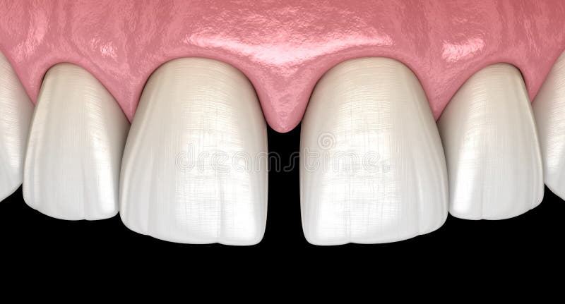 Diastema of central incisors teeth. Dental disfunction 3D illustration. Concept royalty free illustration